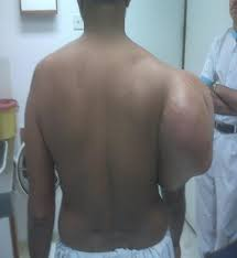 Near The Shoulder Defects Near The Shoulder Defects