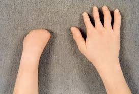 Near The Wrist Defects Near The Wrist Defects